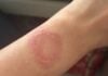 Apple Watch leaves user with burn scar, support case drags on for months